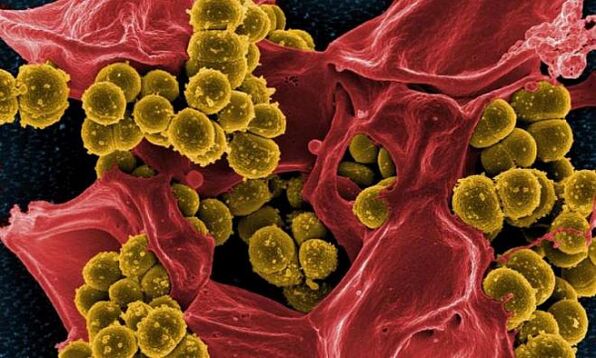 Staphylococcus aureus is the cause of bacterial prostatitis