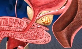 Prostate inflammation